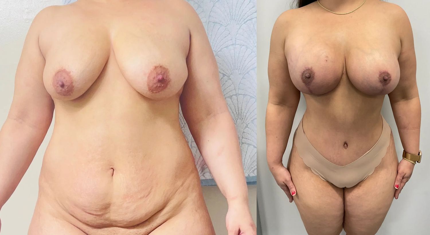 Abdominoplasty Before & After
