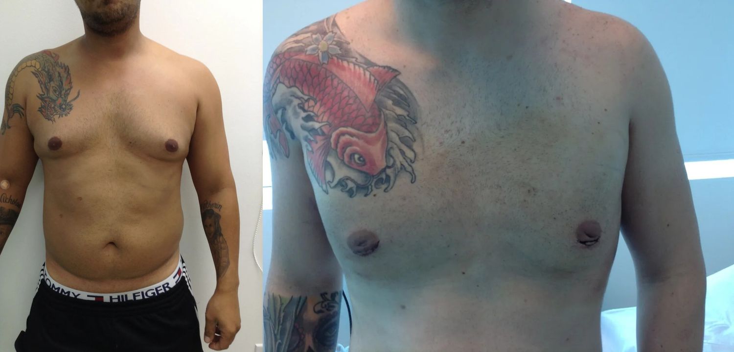 Gynecomastia Before & After