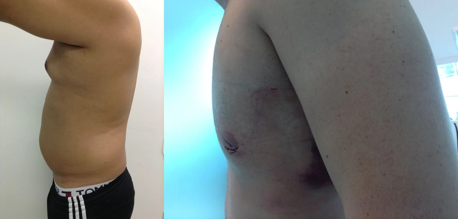 Gynecomastia Before & After