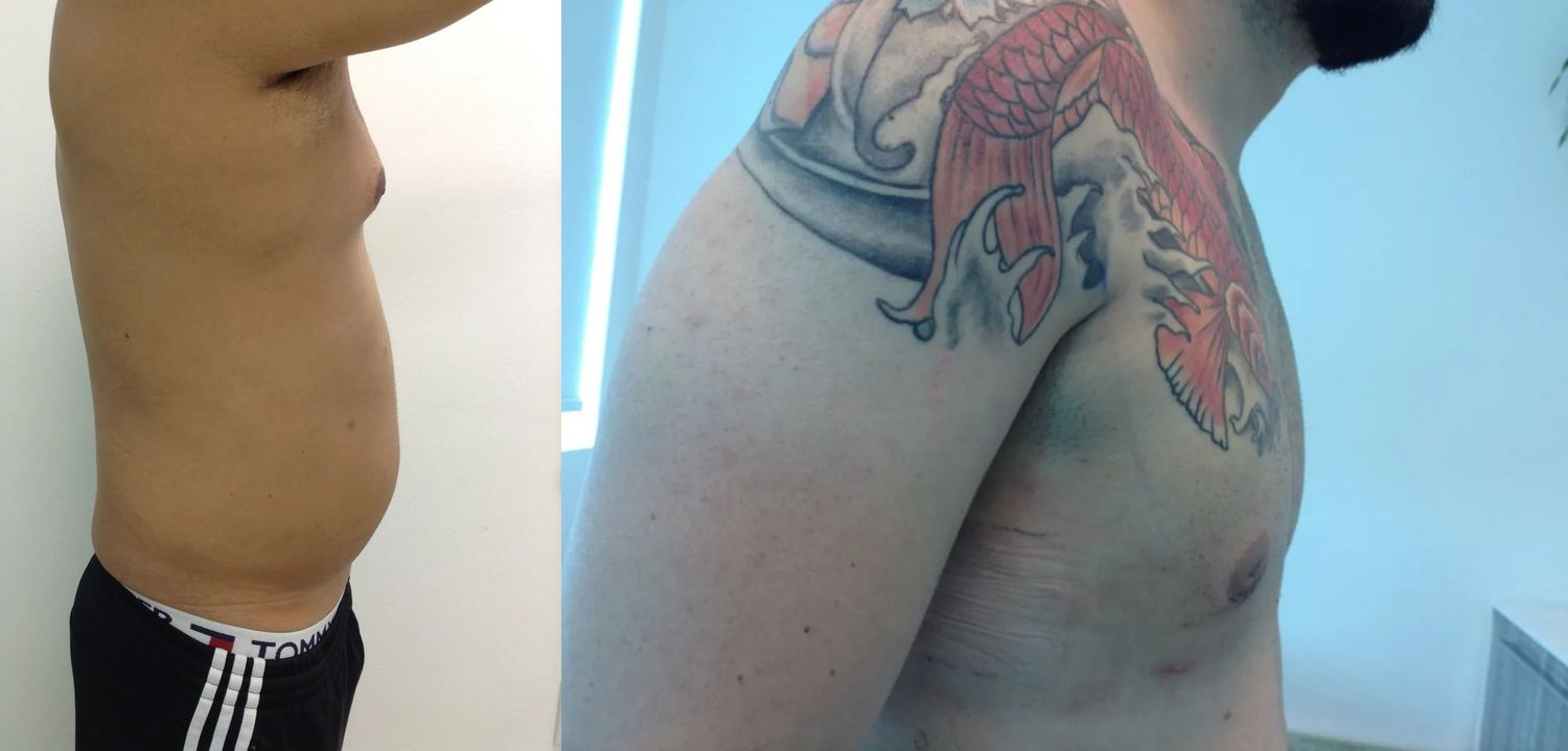 Gynecomastia Before & After