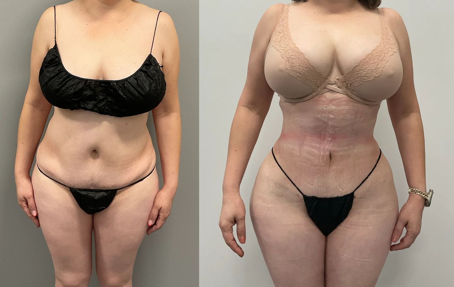 Liposuction Before & After